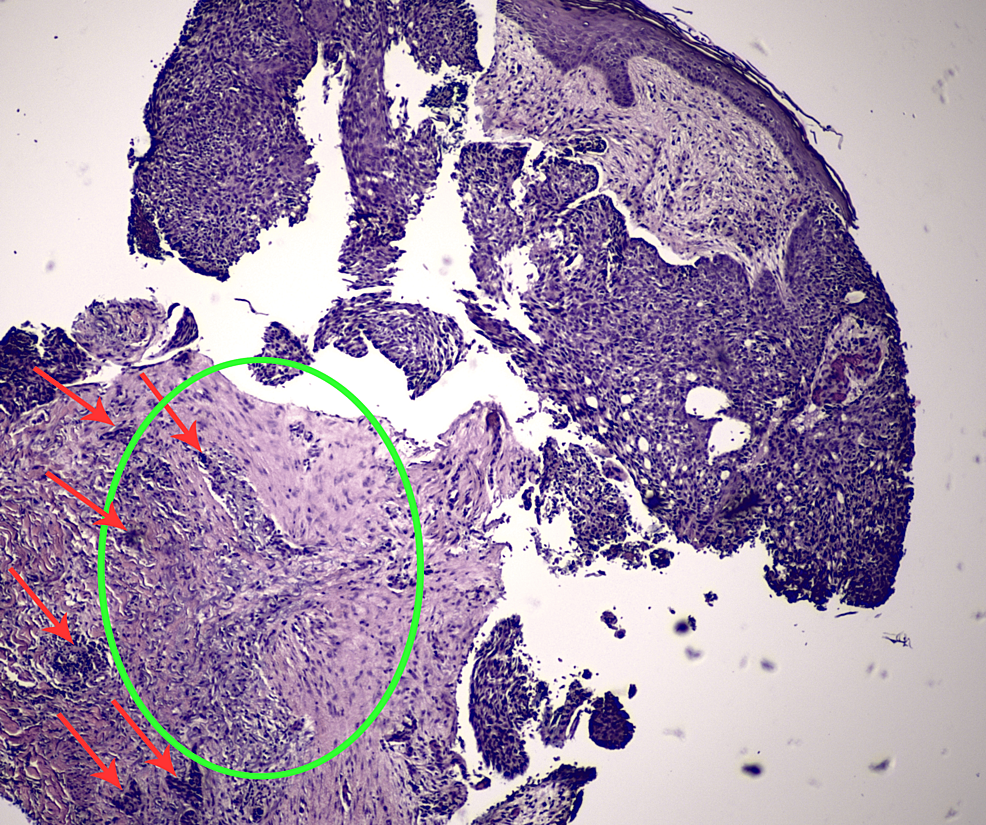 Cureus Annular Basal Cell Carcinoma Expanding Around Central