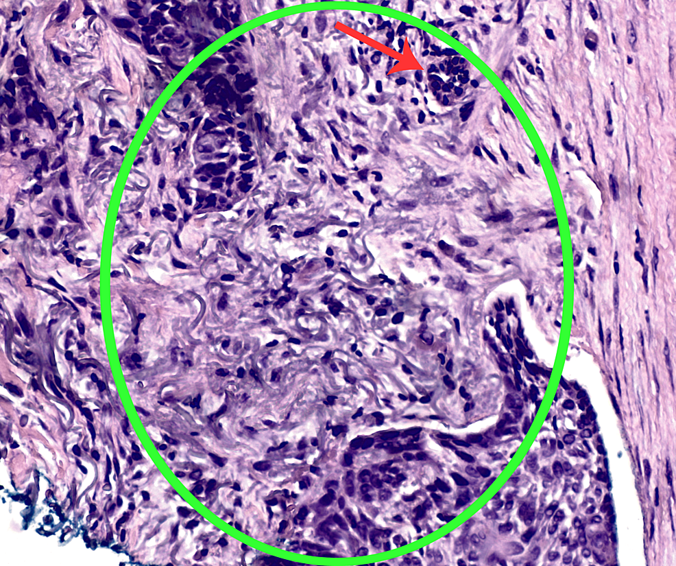 Cureus Annular Basal Cell Carcinoma Expanding Around Central