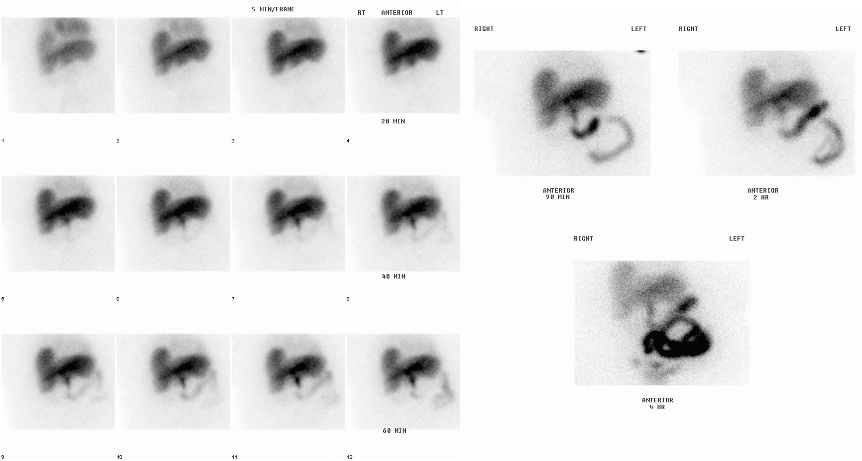 An Unusual Case of Acute Cholecystitis Caused by Lactobacillus