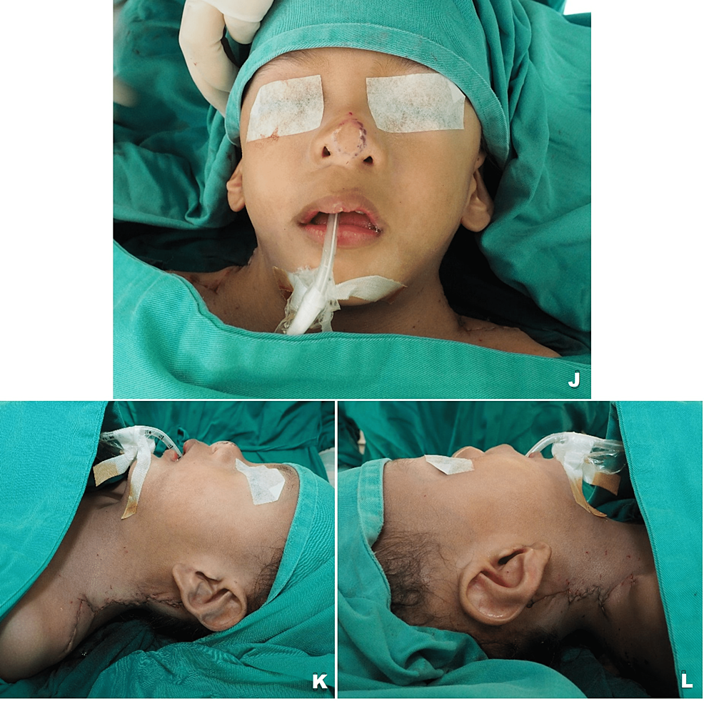 Cureus Modified FiveFlap Zplasty for Surgical Correction of bed