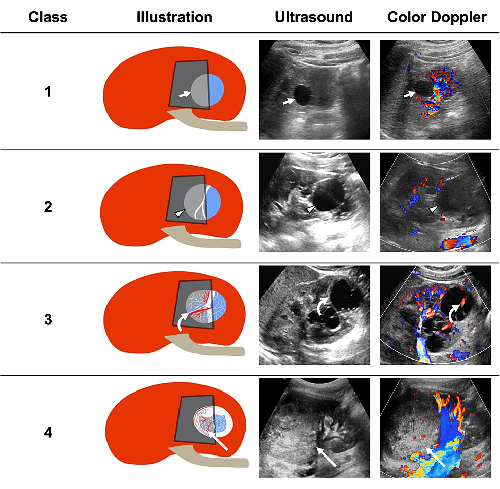 Cureus | The Modified Bosniak Classification For Intermediate And High ...