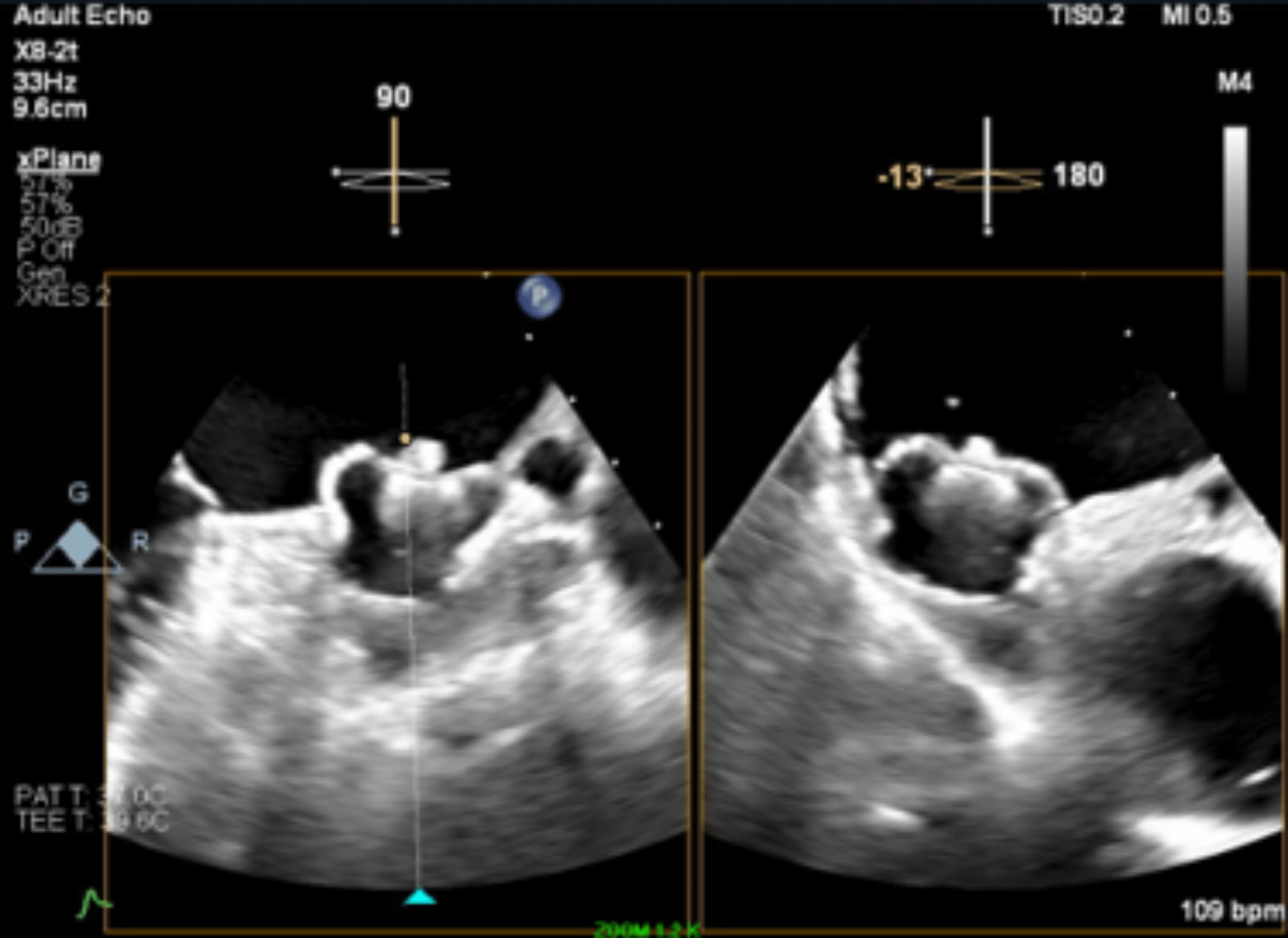 Cureus A Case of Unintentional Release of the Watchman FLX Device