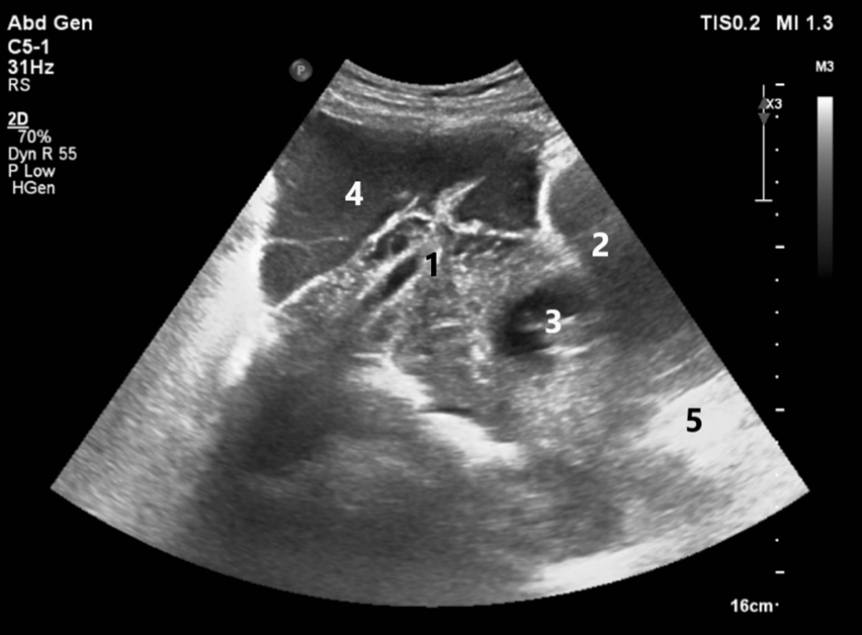 It Is Not Always an Ectopic or Heterotopic Pregnancy Cureus