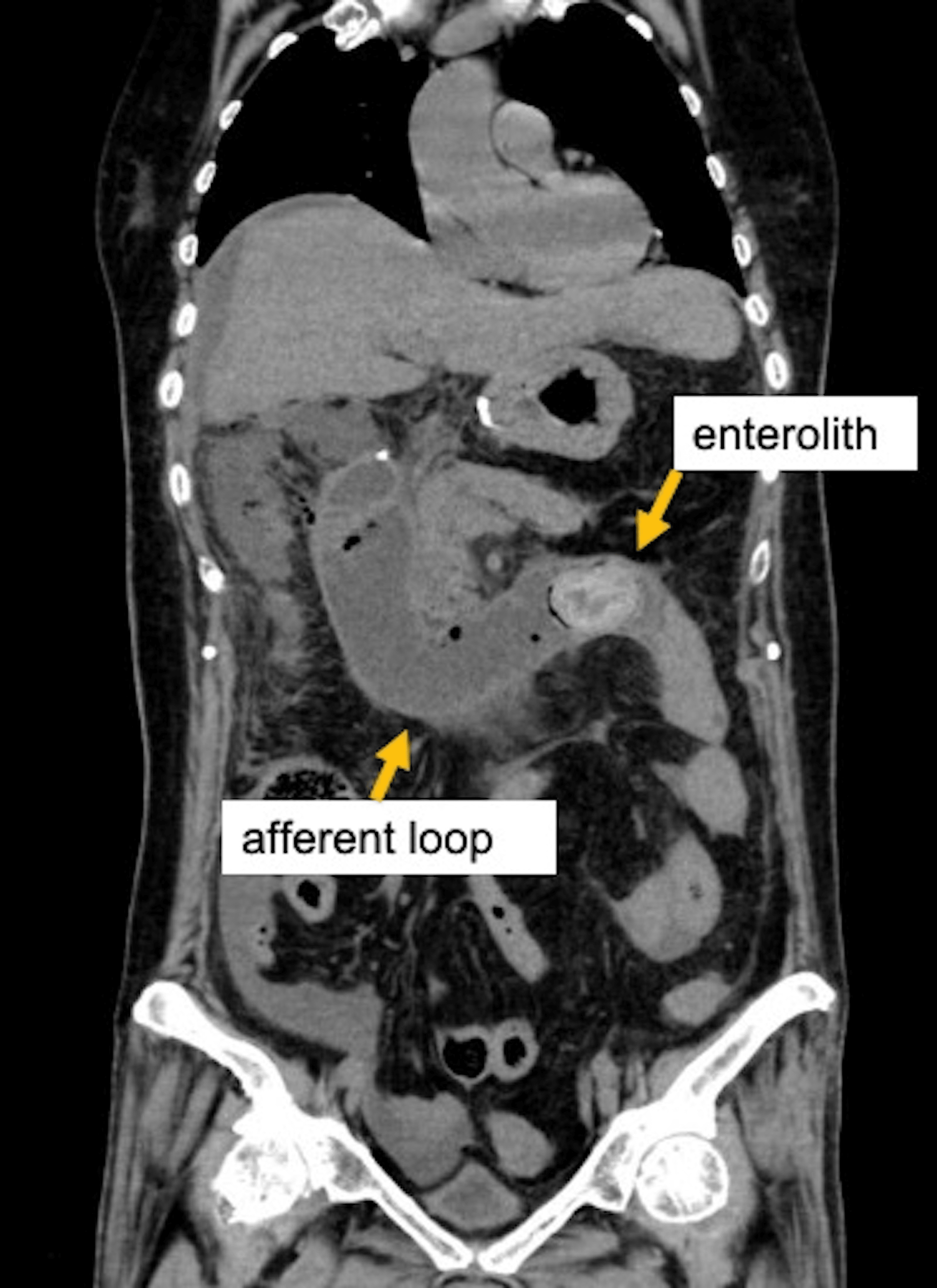 Cureus | Enterolith Causing Afferent Loop Perforation After Distal ...