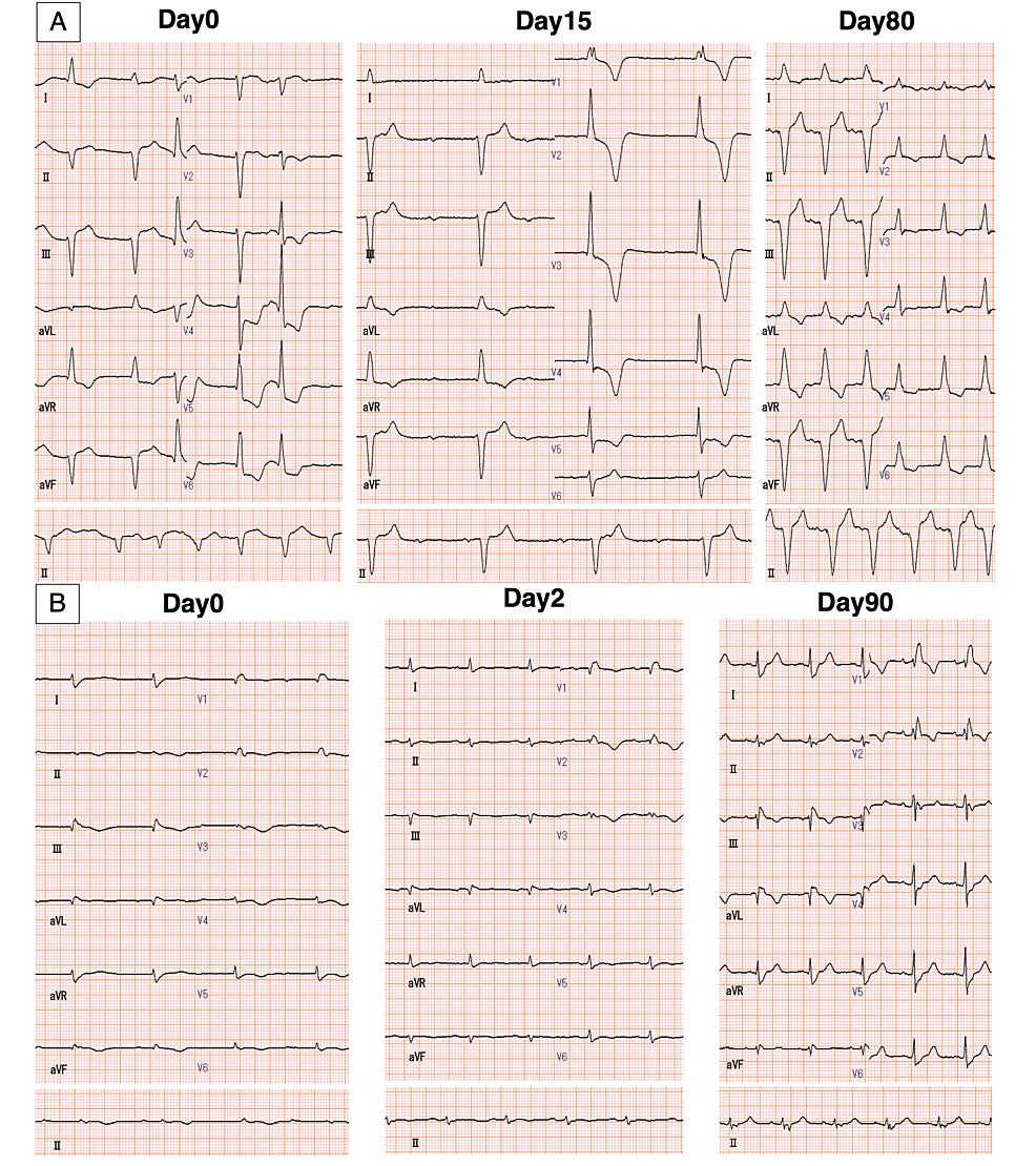 Cureus | Two Cases of Immune Checkpoint Inhibitor-Induced Myocarditis ...