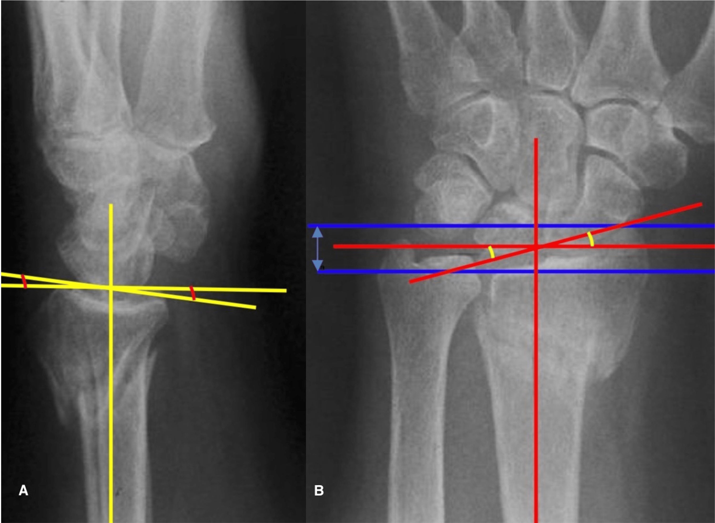 Distal Radius ExtraArticular Fractures The Impact of Anatomical