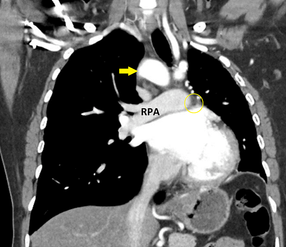 Cureus A Rare Case Of Right Sided Aortic Arch With Mirror Image