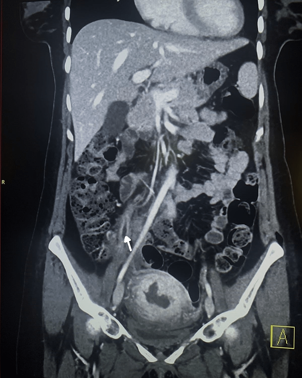 Cureus Postpartum Septic Pelvic Thrombophlebitis in a Tertiary
