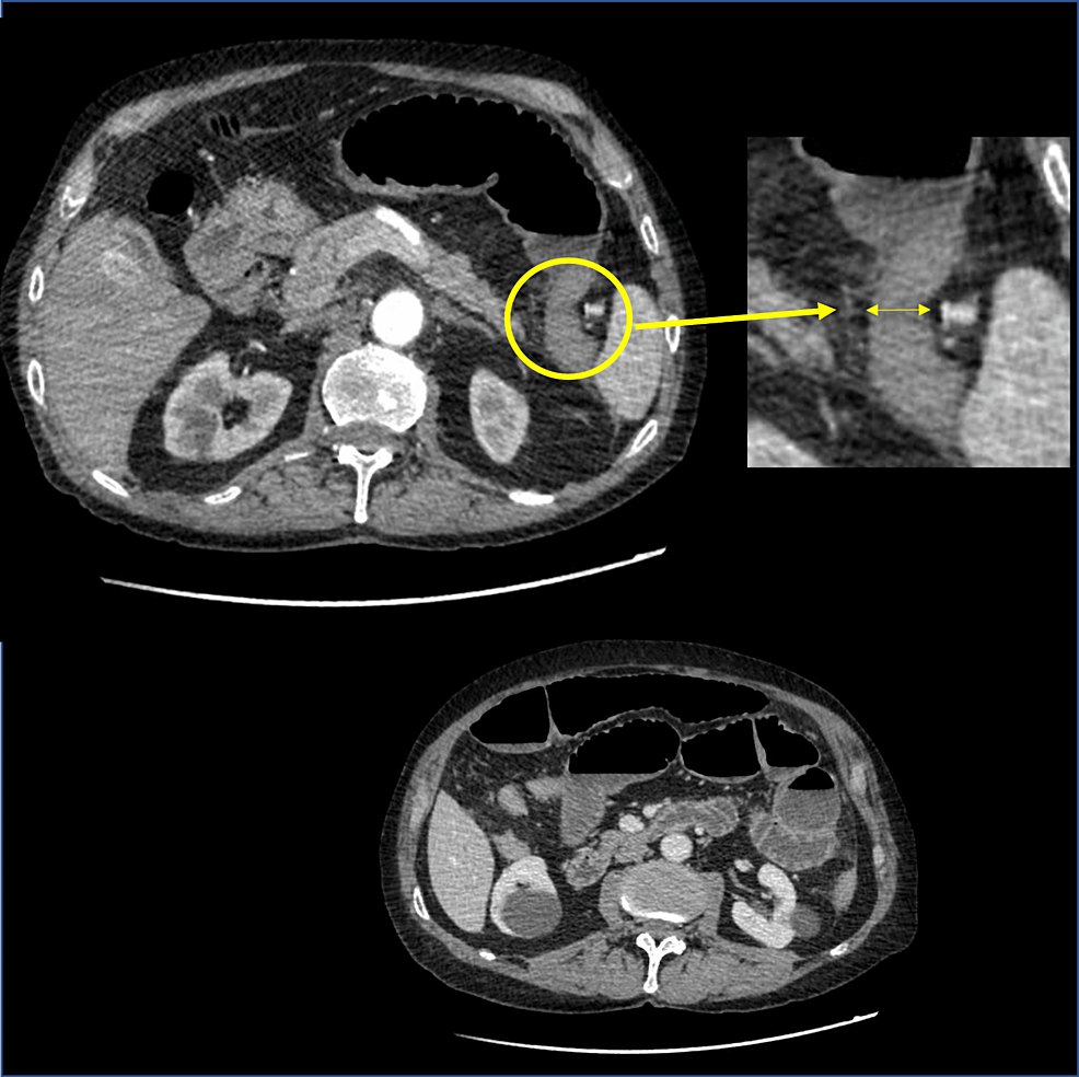 cureus-an-occlusive-form-of-acute-gangrenous-appendicitis-with