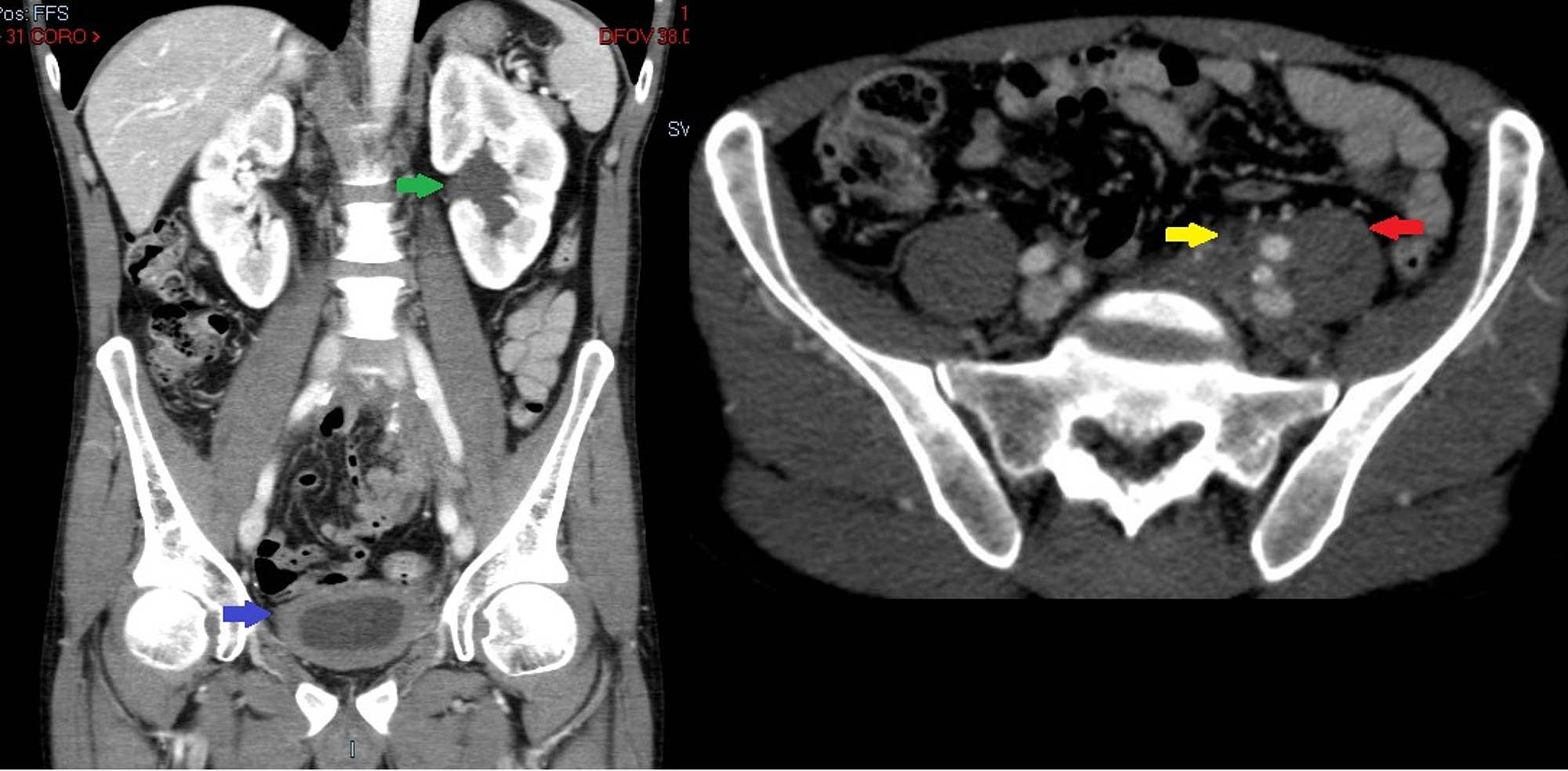 Cureus Idiopathic Retroperitoneal Fibrosis Presenting As Low Back Pain