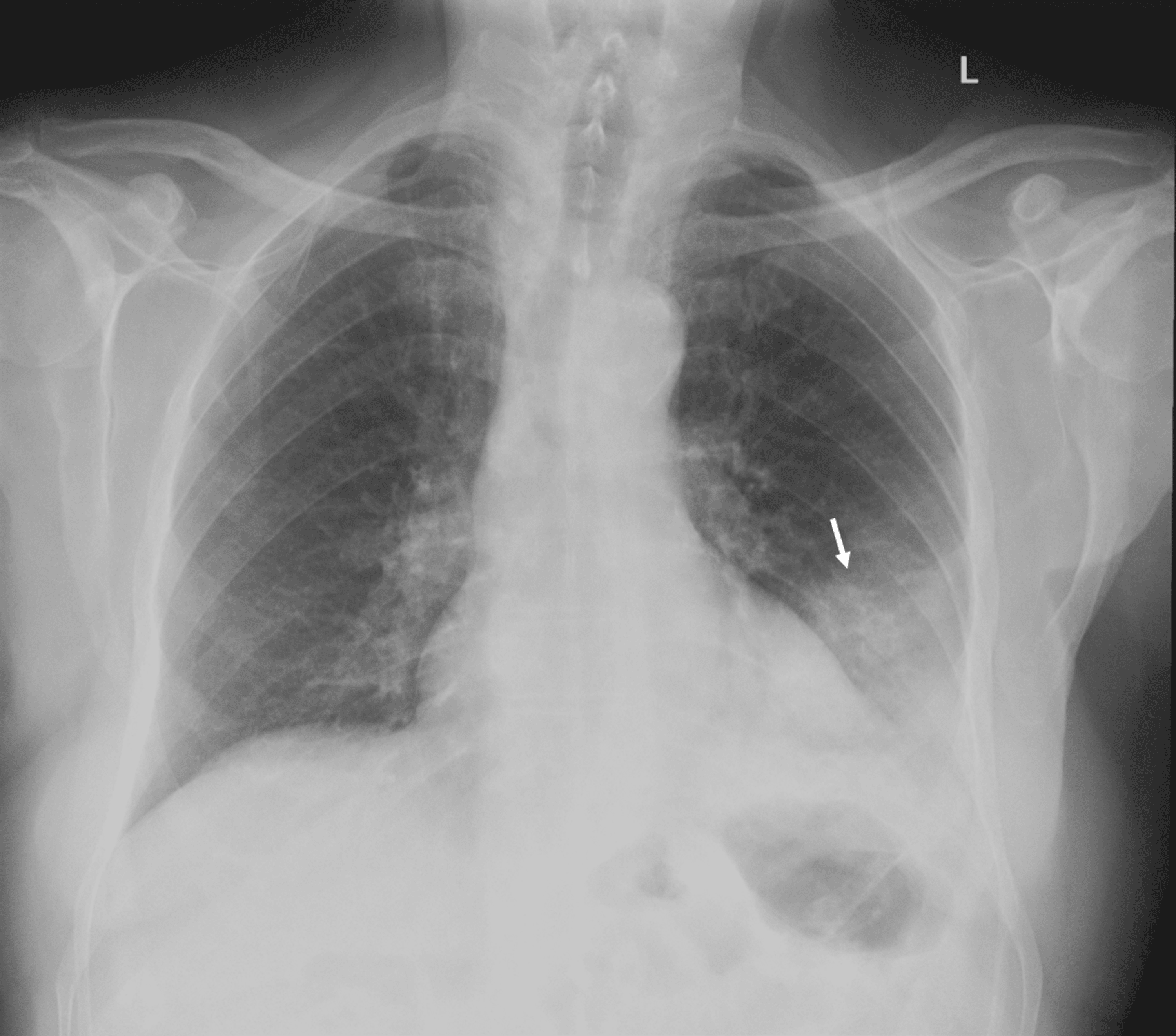 Left lower lobe pneumonia symptoms
