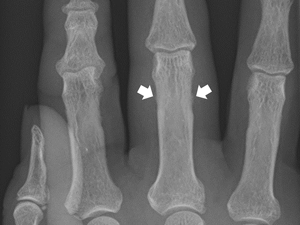 Cureus Differentiating Between Undifferentiated Peripheral