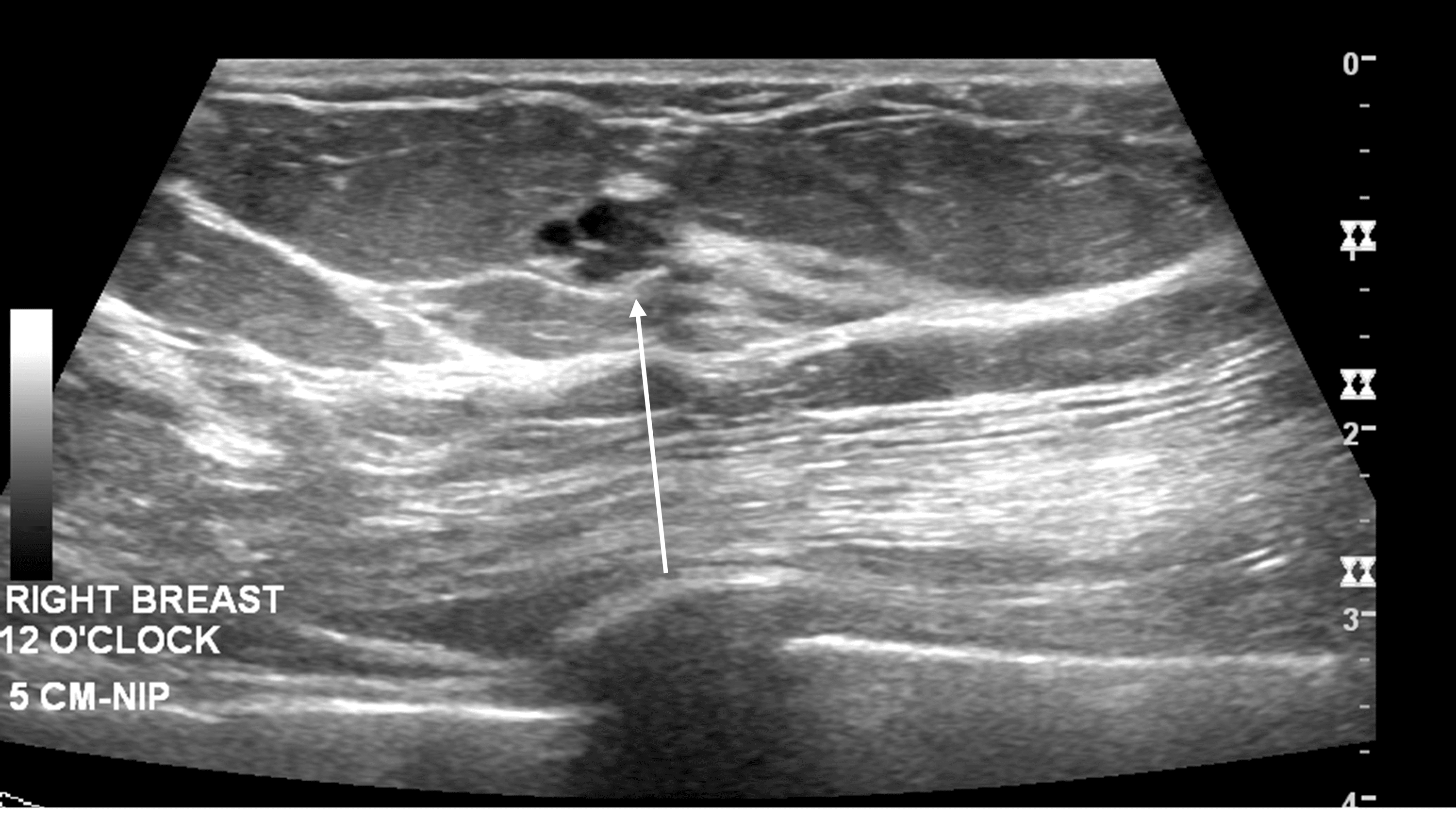 Cureus An Interesting Imaging Presentation Of A Common Benign Entity