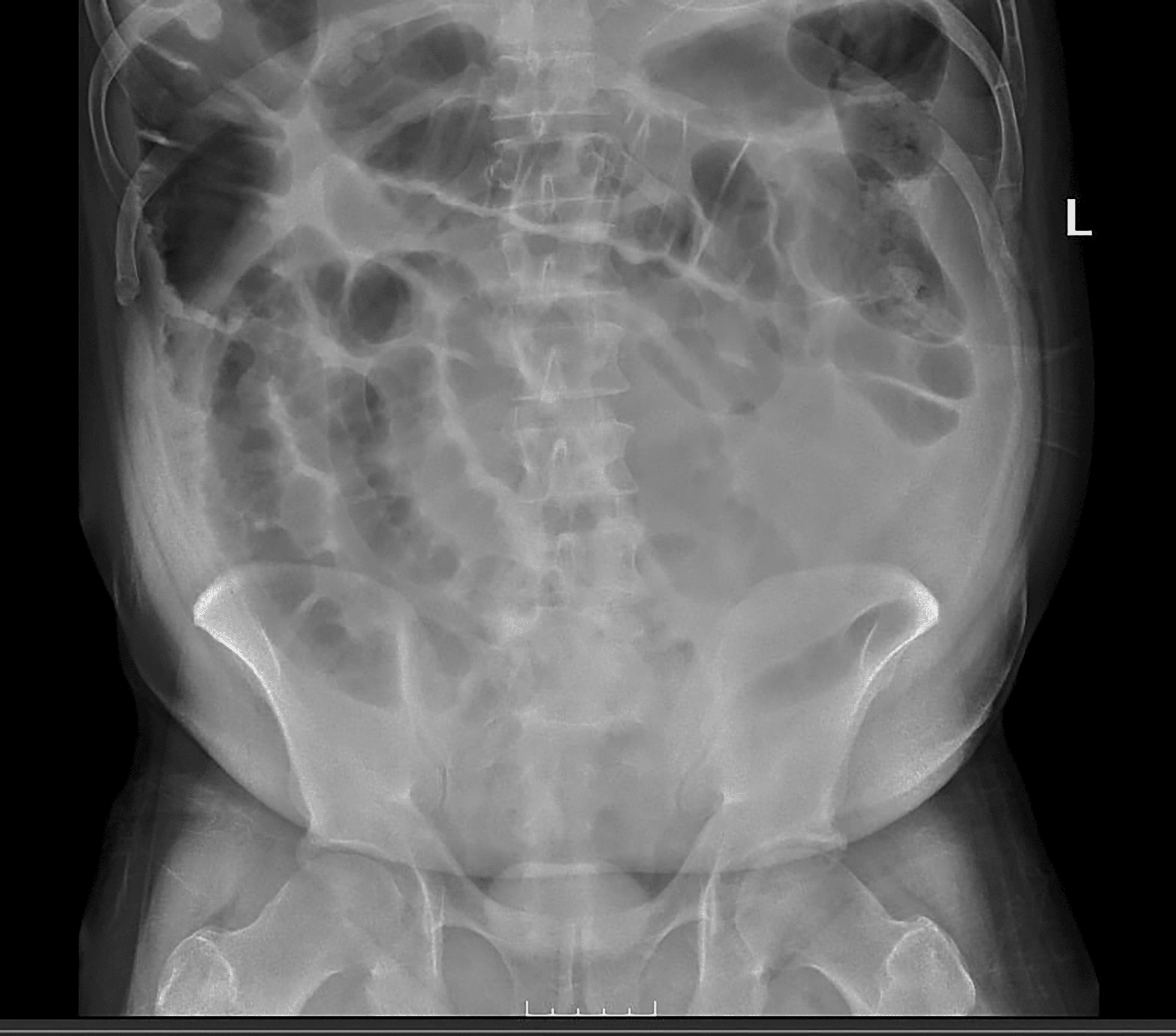 Cureus OlmesartanInduced Ischemic Enteritis Complicated With Bowel