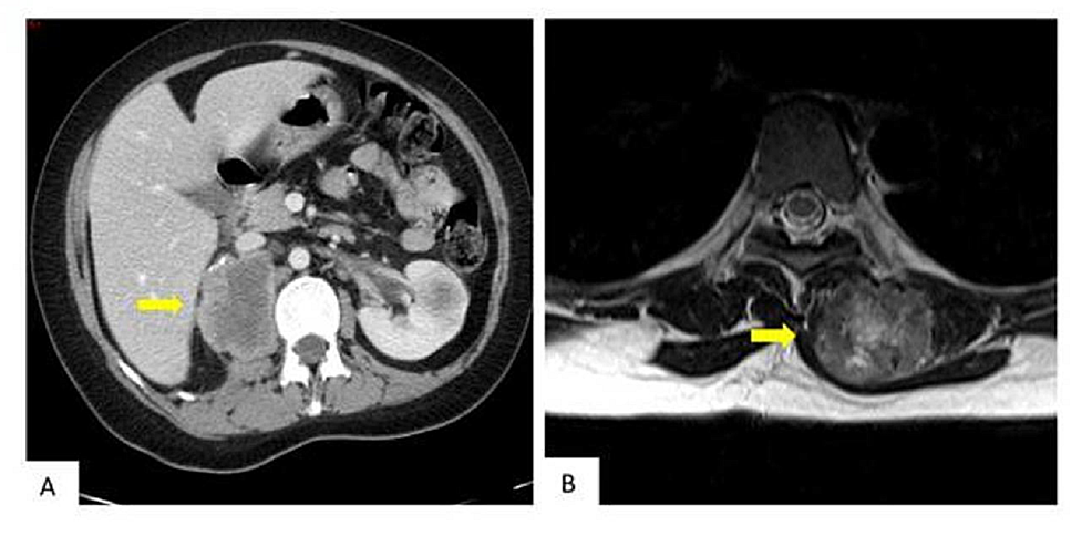 Follow-up-Images-(Abdominal-and-Pelvic-CT-Scan/MRI)