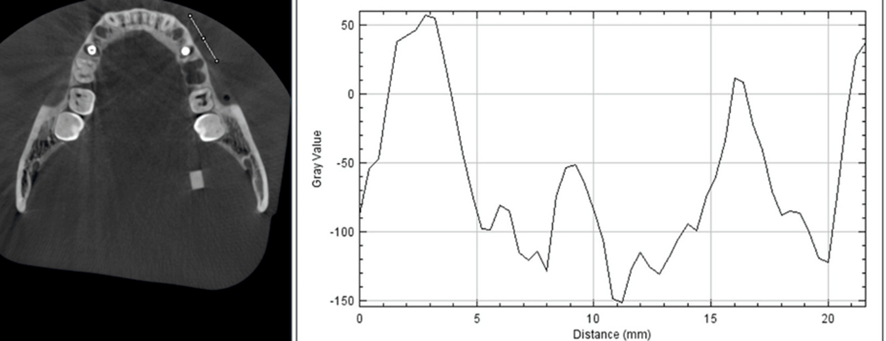 Cureus Effect of Mandible Phantom Inclination in the Axial Plane on