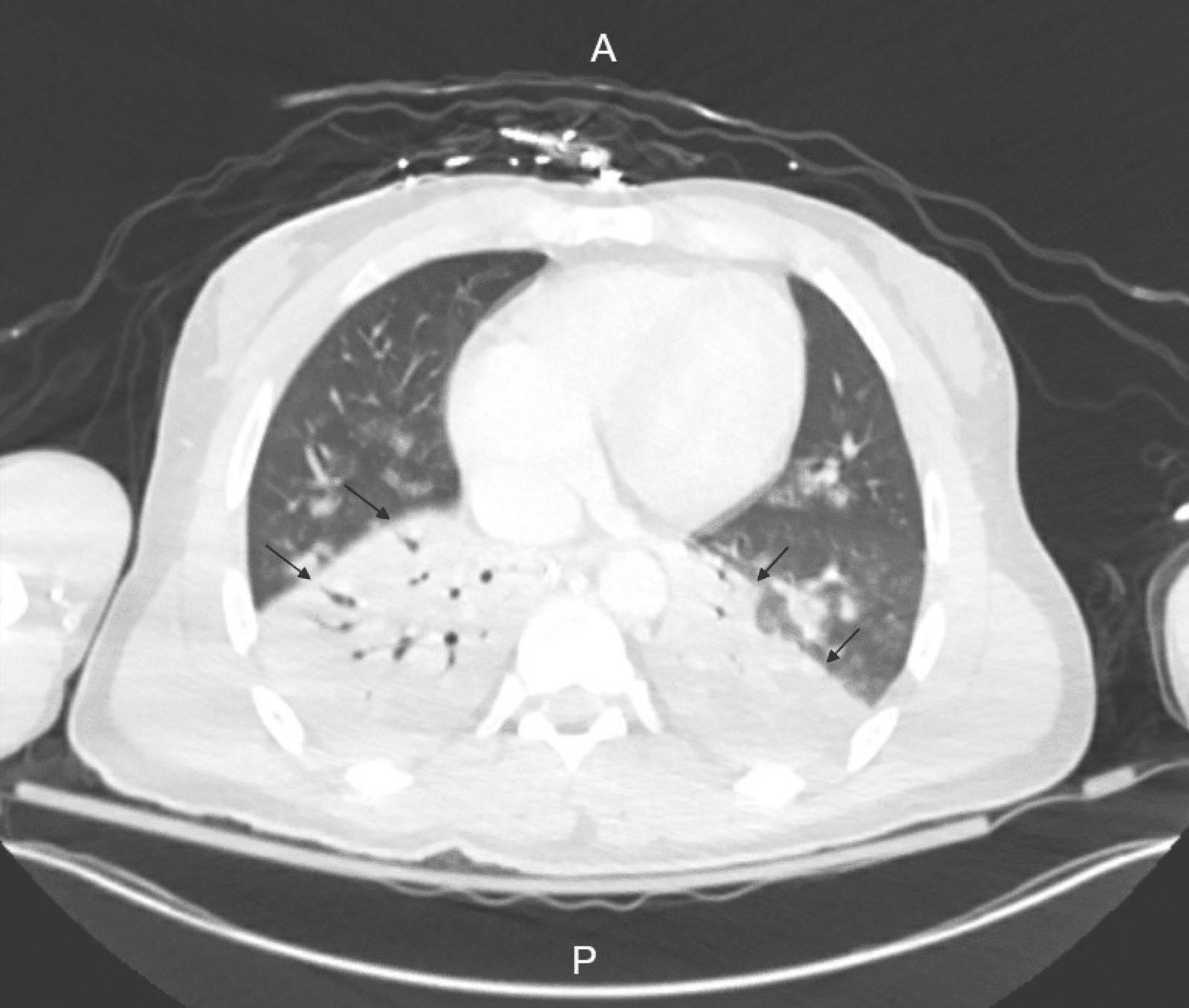 An Unusual Cause of Persistent Tachycardia Atypical Neuroleptic