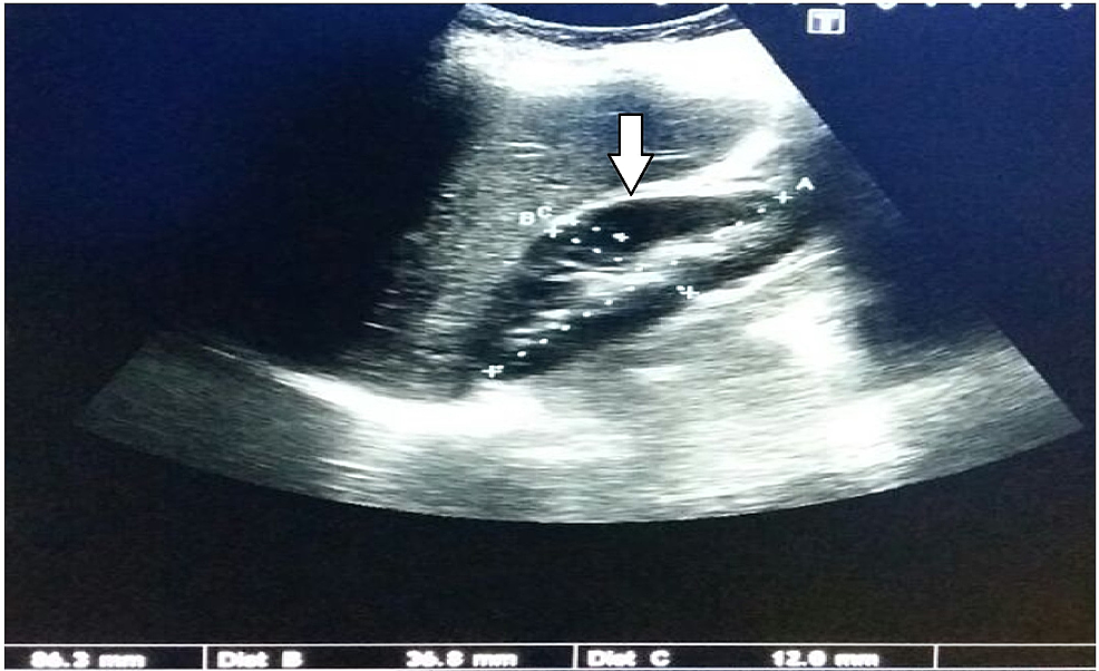 Cureus Role Of Ultrasound In The Diagnosis Of Chronic Kidney Disease 