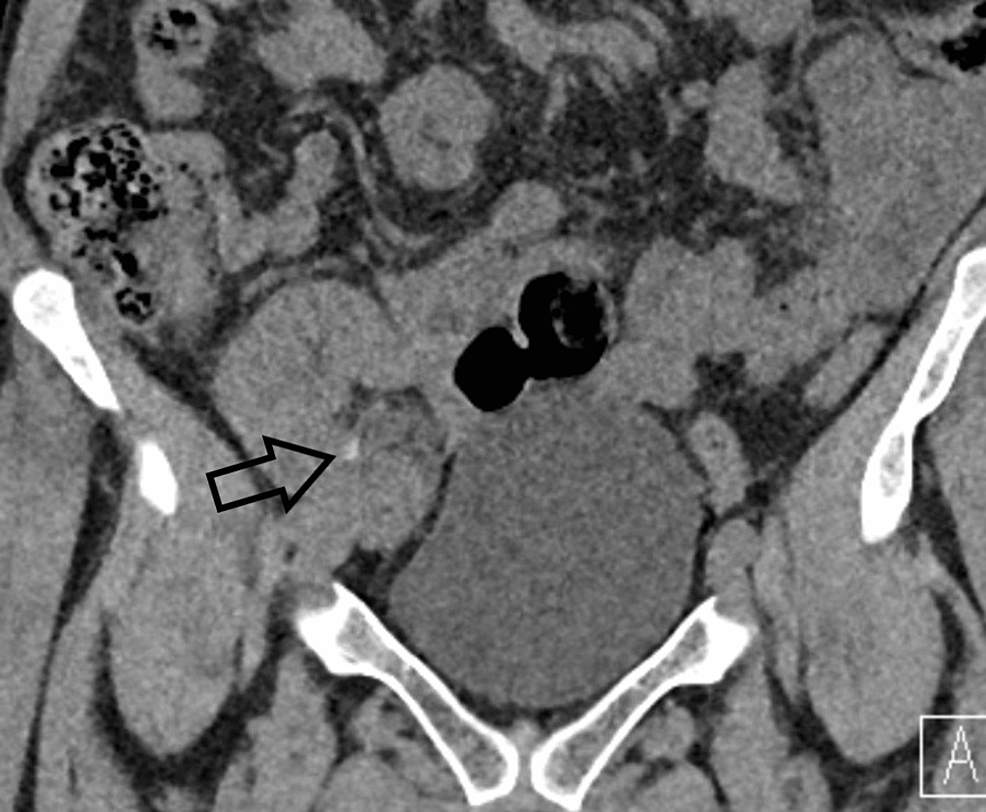 Cureus Radiolucent Matrix Stones in a Transplanted Kidney A Case Report