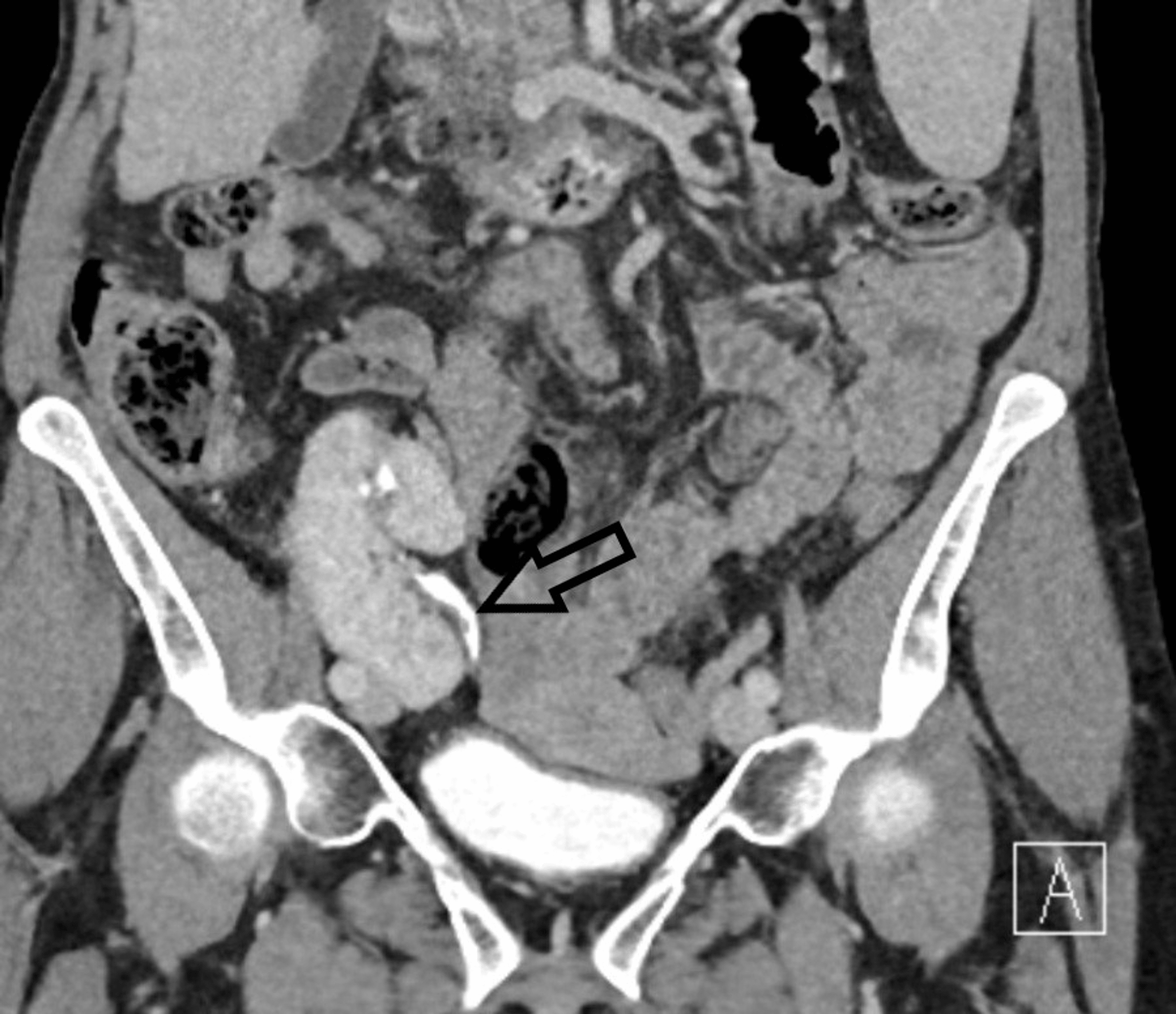 Cureus Radiolucent Matrix Stones in a Transplanted Kidney A Case Report