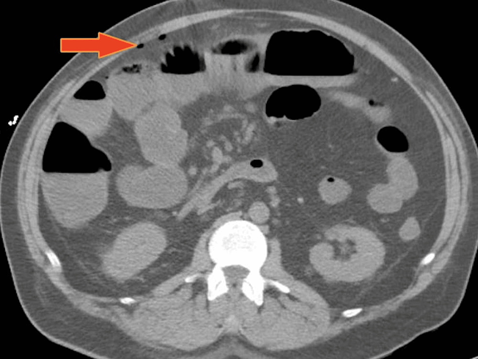 Cureus OlmesartanInduced Ischemic Enteritis Complicated With Bowel