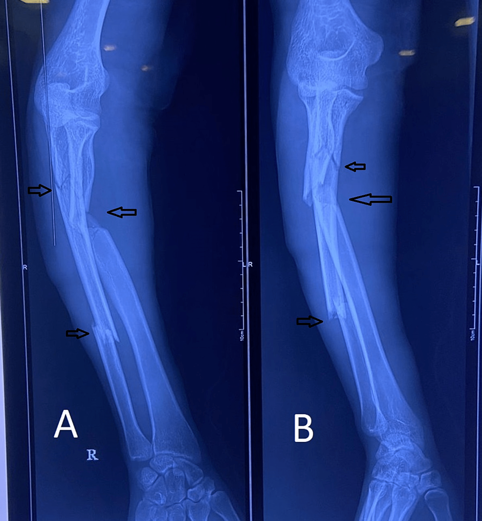 A study on management of extracapsular trochanteric fractures by proximal  femoral nail