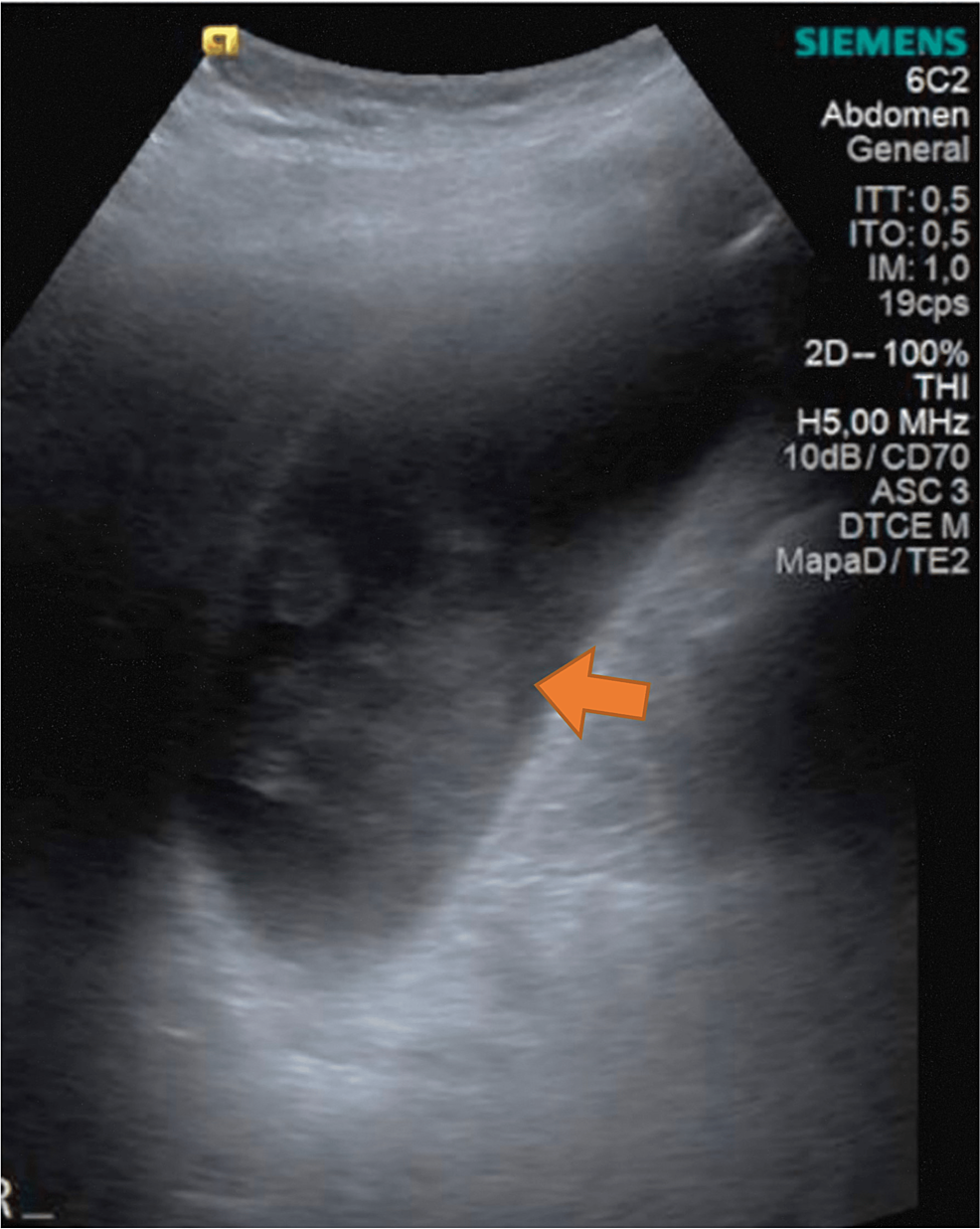 cureus-synchronous-acute-appendicitis-and-acute-cholecystitis