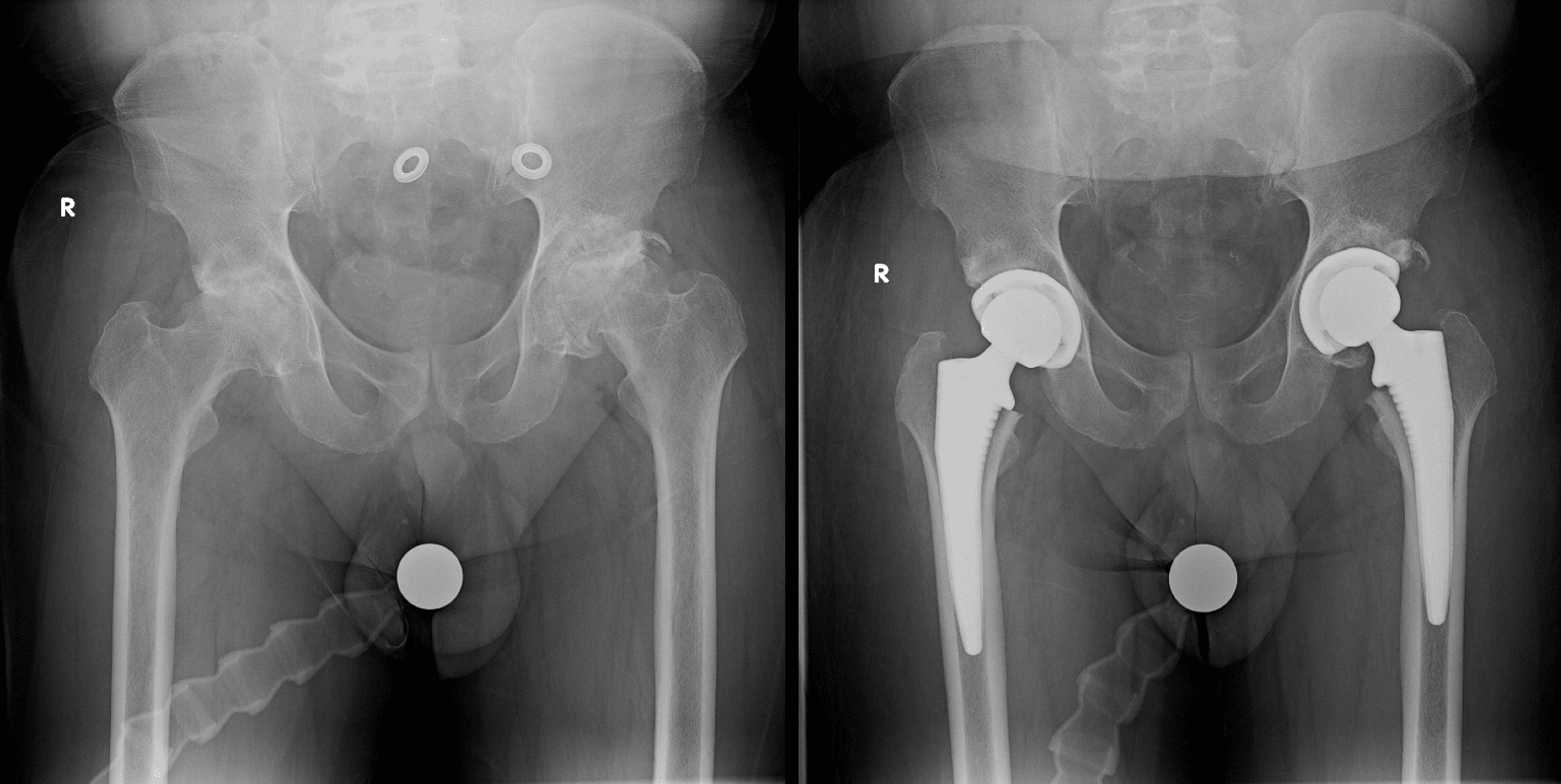 Cureus Periarticular Injection Versus Peripheral Nerve Blockade in Bilateral Total Hip