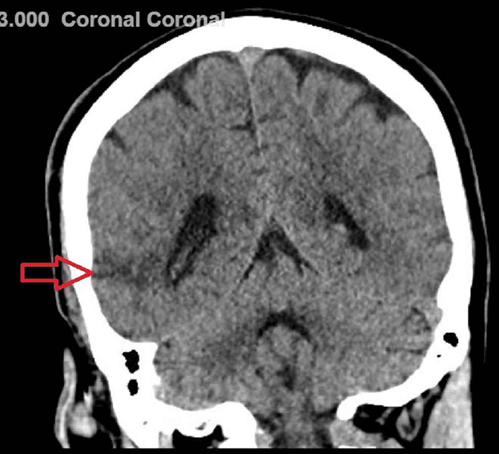 Cureus A Unique Case of the Syndrome of Irreversible Lithium