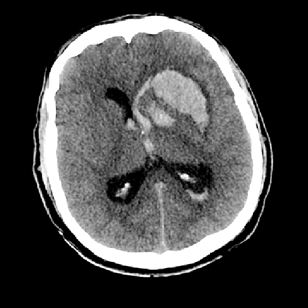 Bleeding Diathesis as the Initial Presentation of Chronic Myeloid ...