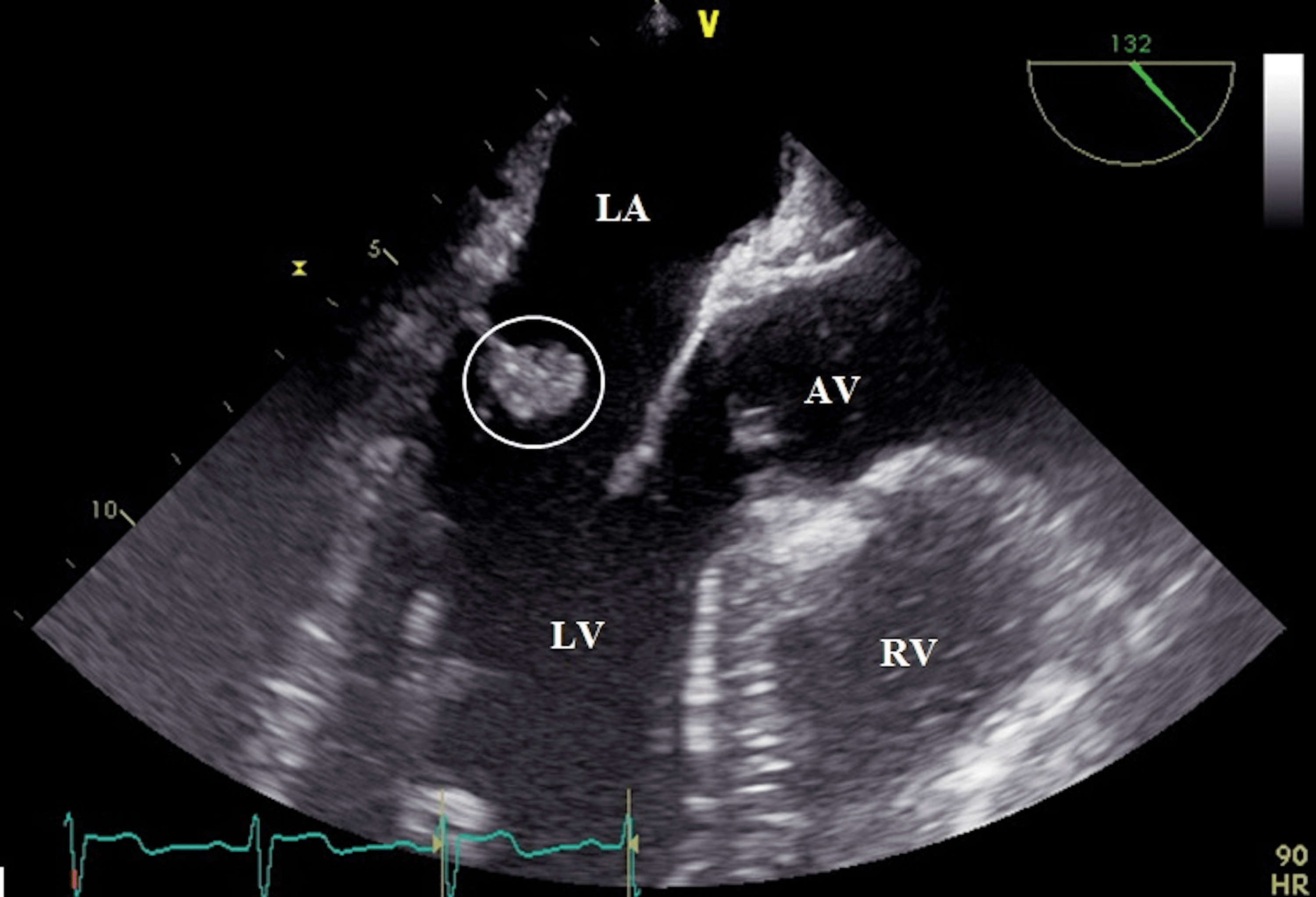 Recurrent Nonbacterial Thrombotic Endocarditis and Primary