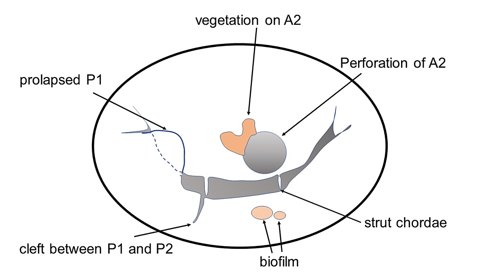 Cureus Posterior Mitral Leaflet Prolapse and Subsequent Mitral Valve