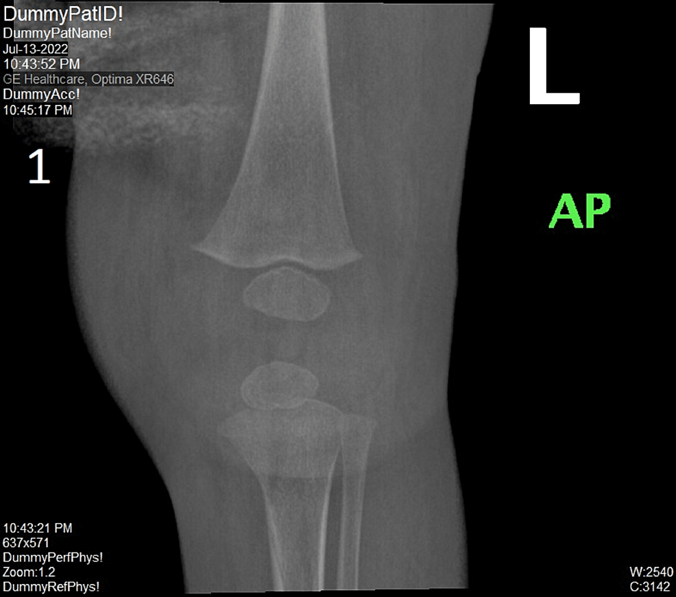 Cureus Bilateral Knee Septic Arthritis In A Seven Month Old Girl