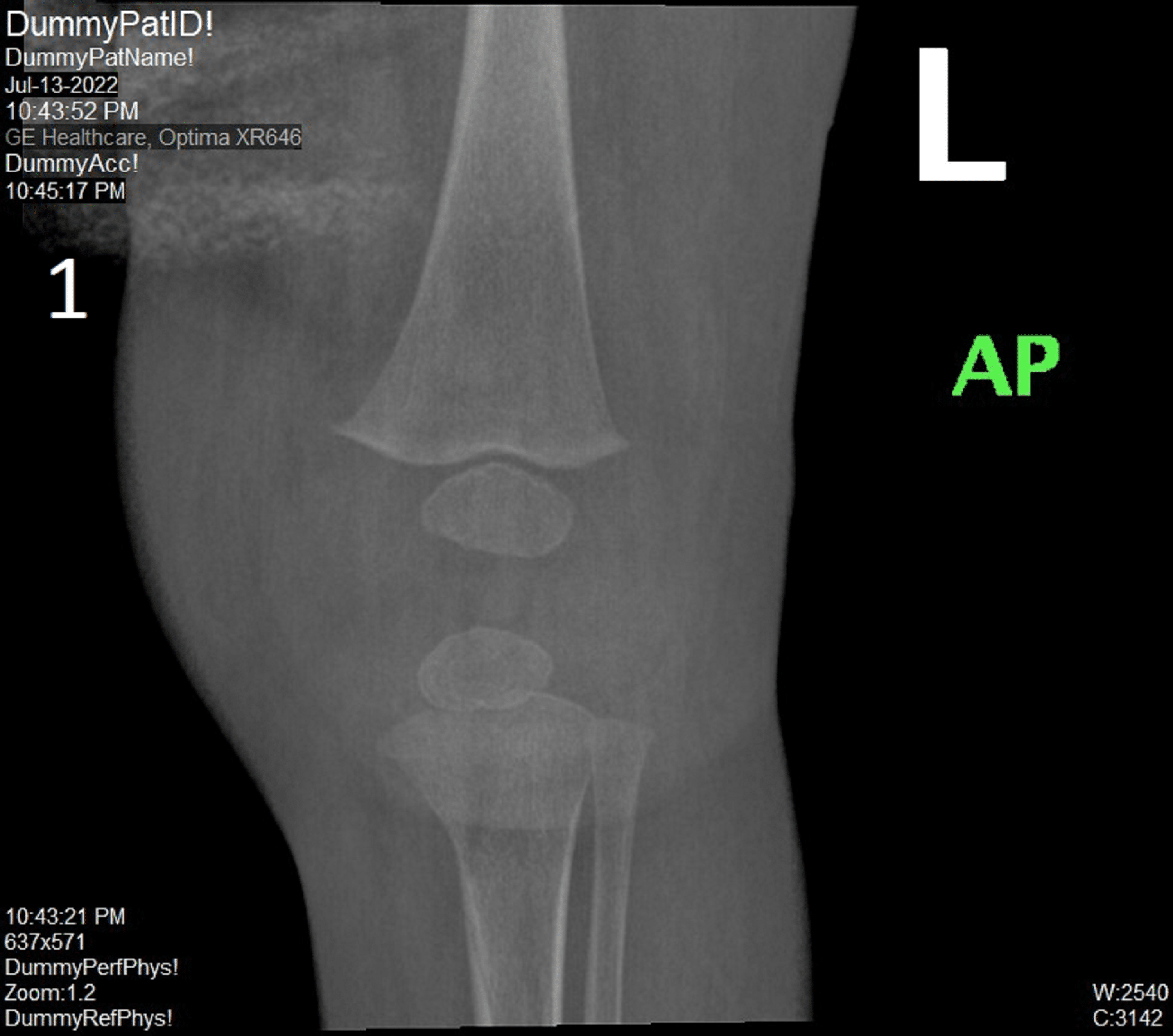 Bilateral Knee Septic Arthritis in a SevenMonthOld Girl Cureus