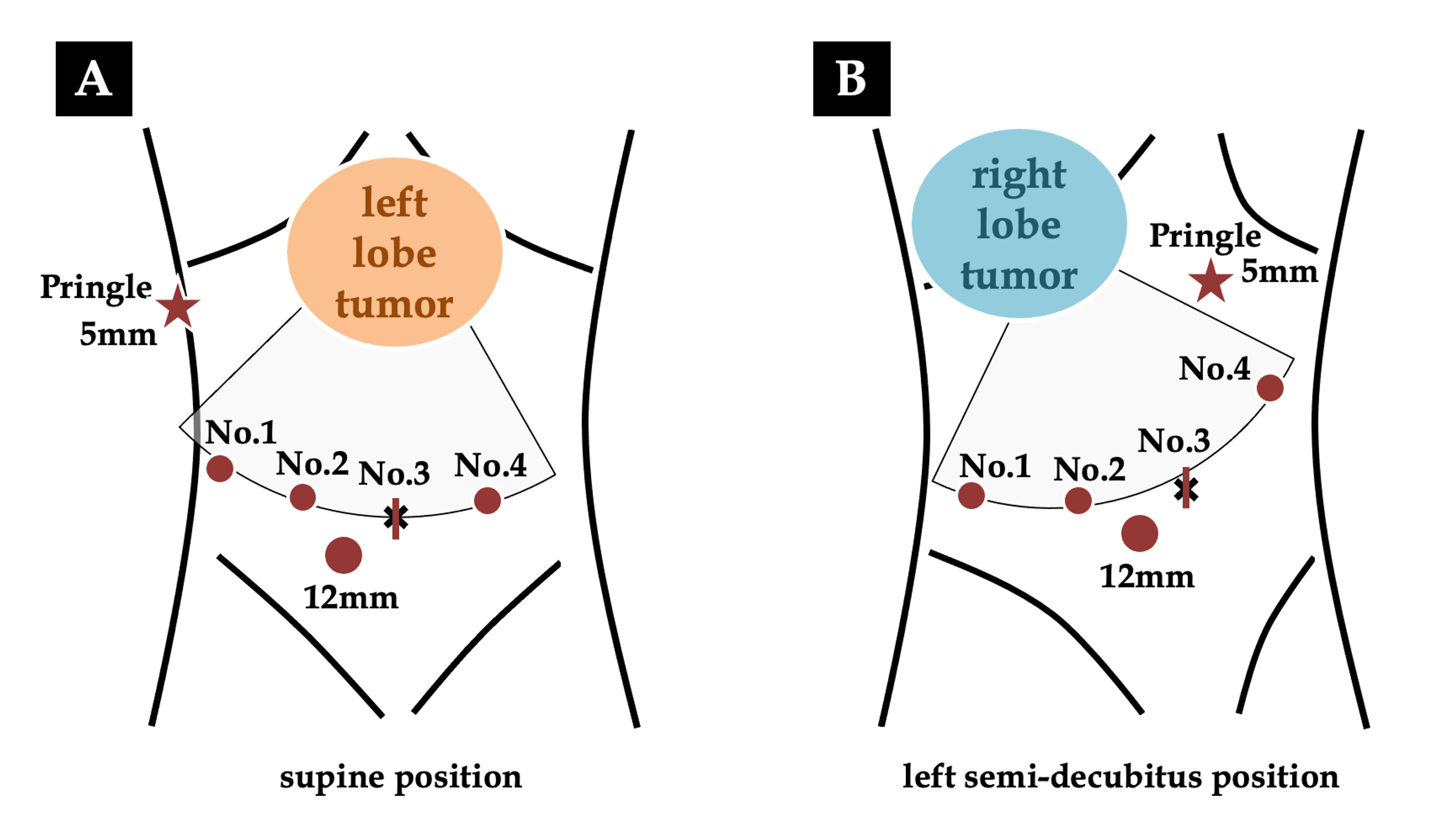 NonStick Liver Parenchymal Transection With SalineLinked Bipolar