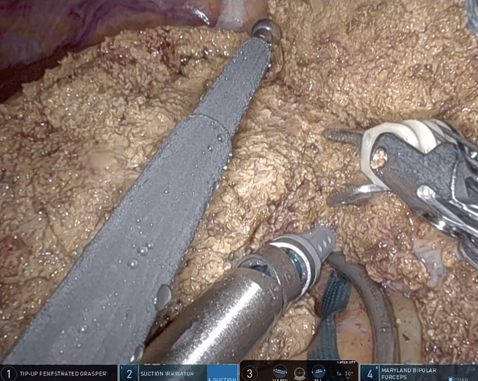 NonStick Liver Parenchymal Transection With SalineLinked Bipolar