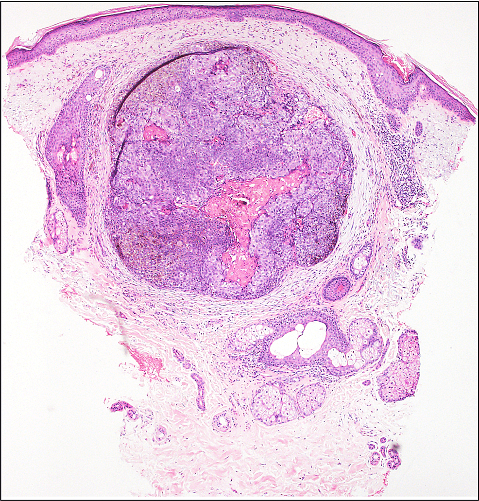 cureus-melanocytic-matricoma-a-potential-mimic-of-malignant-melanoma