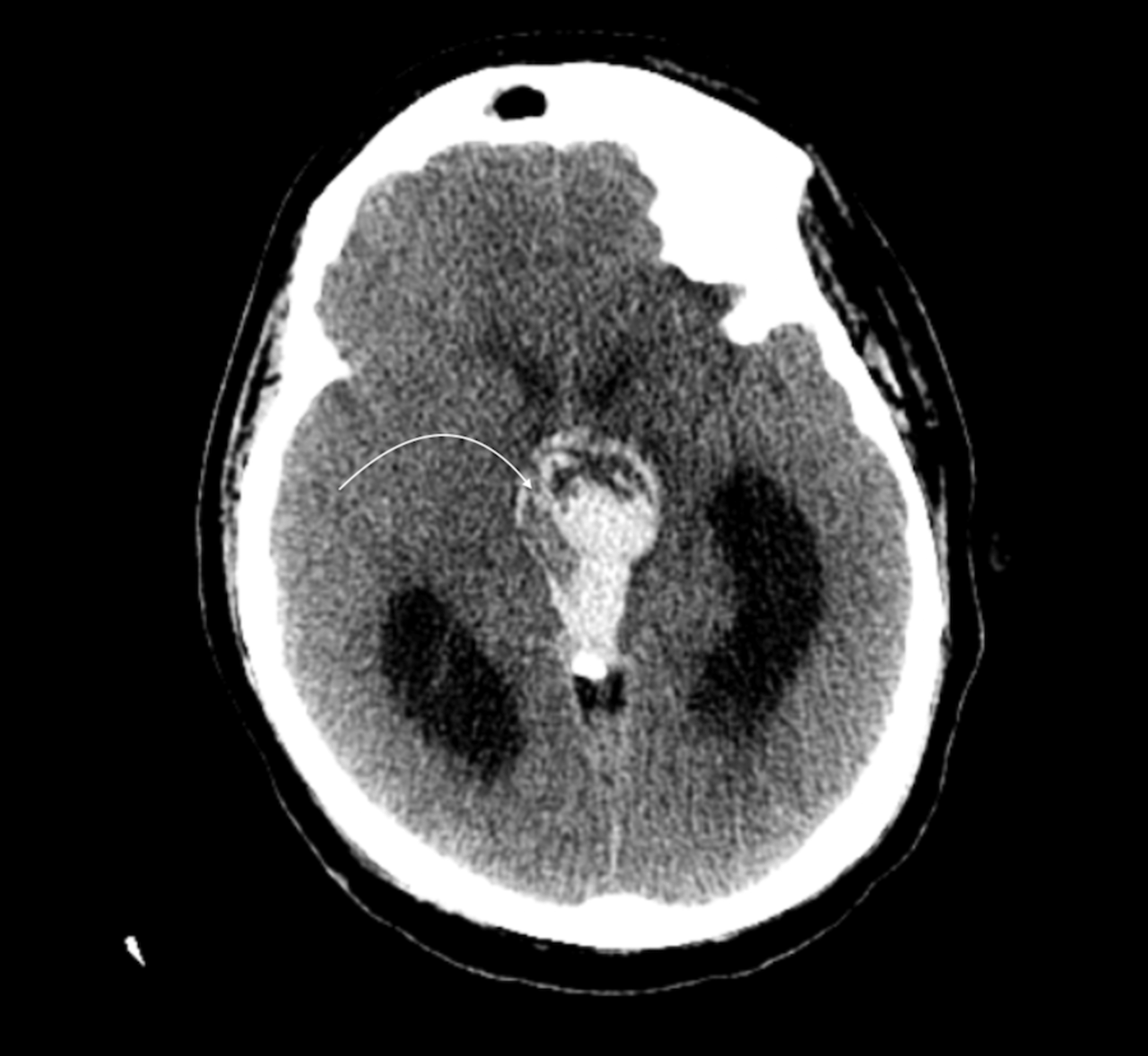 Cureus | Atypical Teratoid/Rhabdoid Tumor Of The Sellar Region In An ...