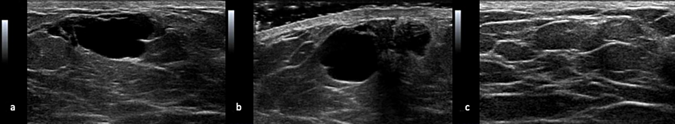 Cureus Benign Breast Cyst In A Young Male