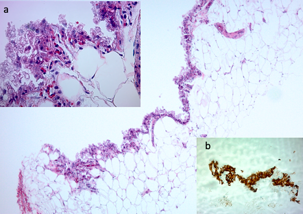 Left-Breast-Biopsy-of-a-Benign-Simple-Cyst