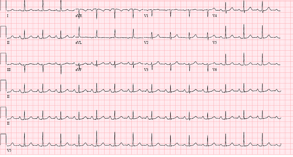 Complete heart block due to COVID-19: a case series and literature review.