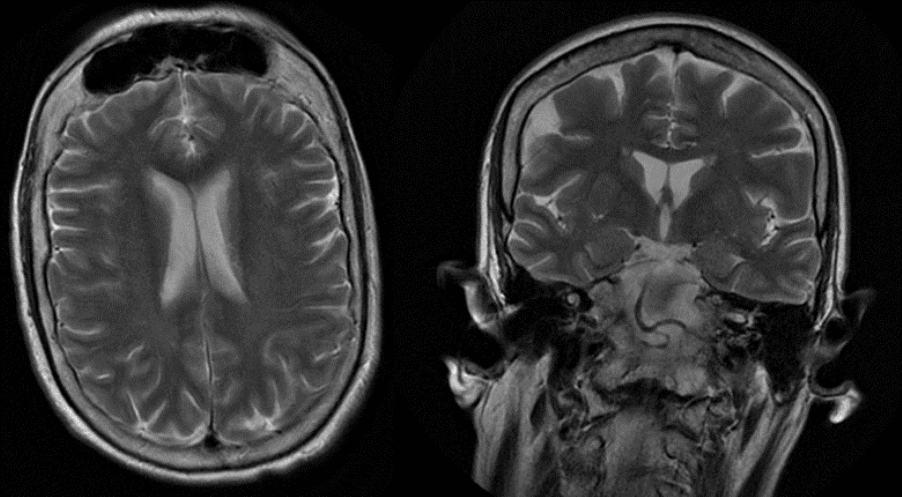 What Does Unremarkable Mean On An Mri - fdsuxuu