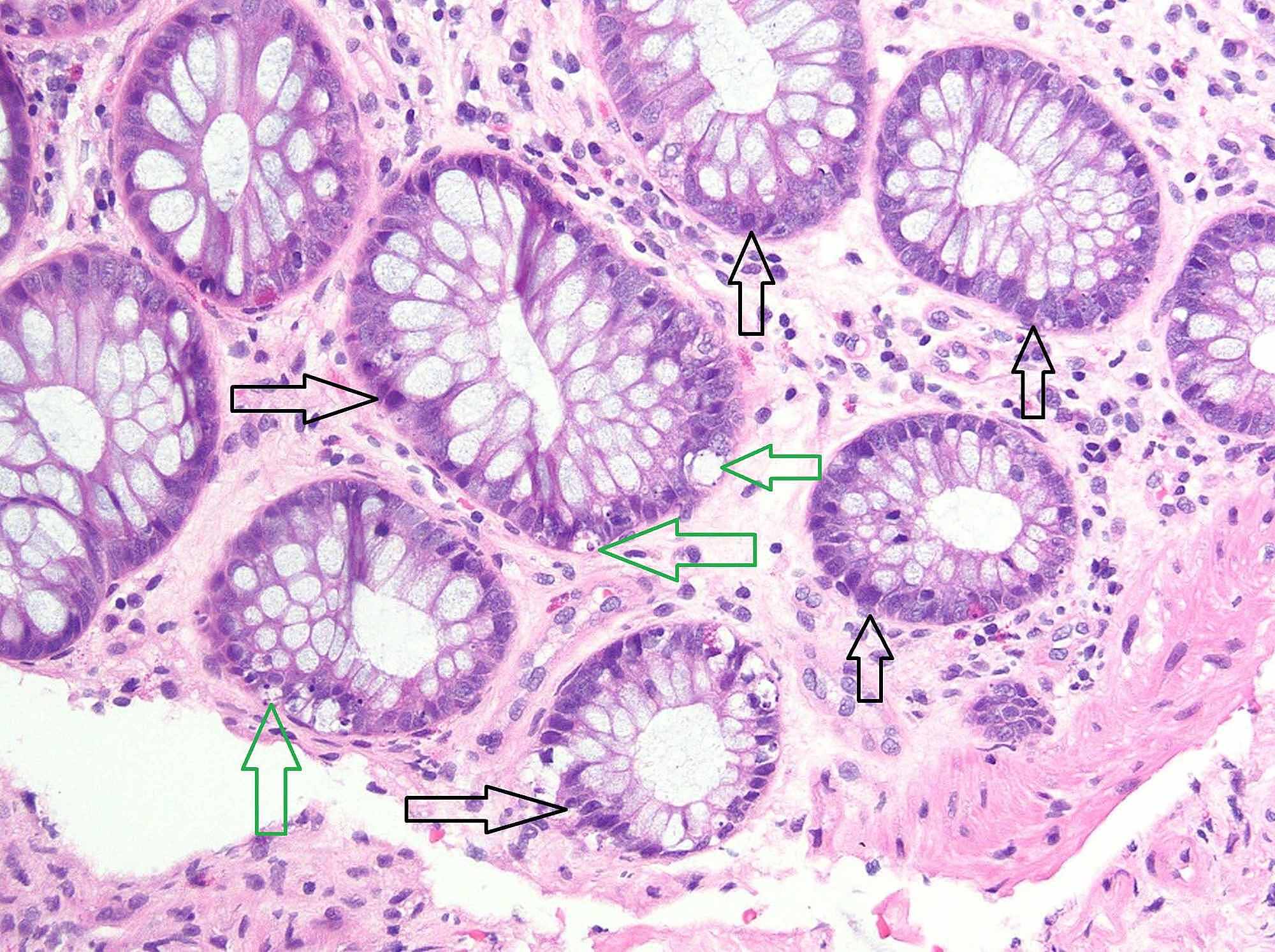 Cureus | Mycophenolate-induced Colitis: A Case Report with Focused ...