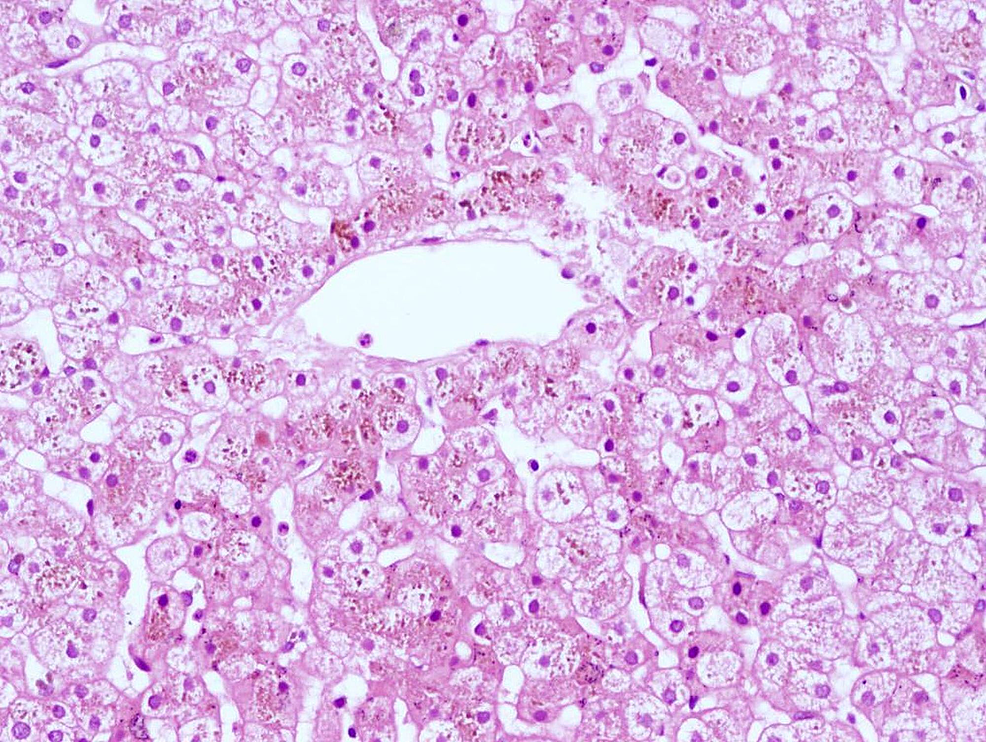 Cureus A Case of DubinJohnson Syndrome in Pregnancy