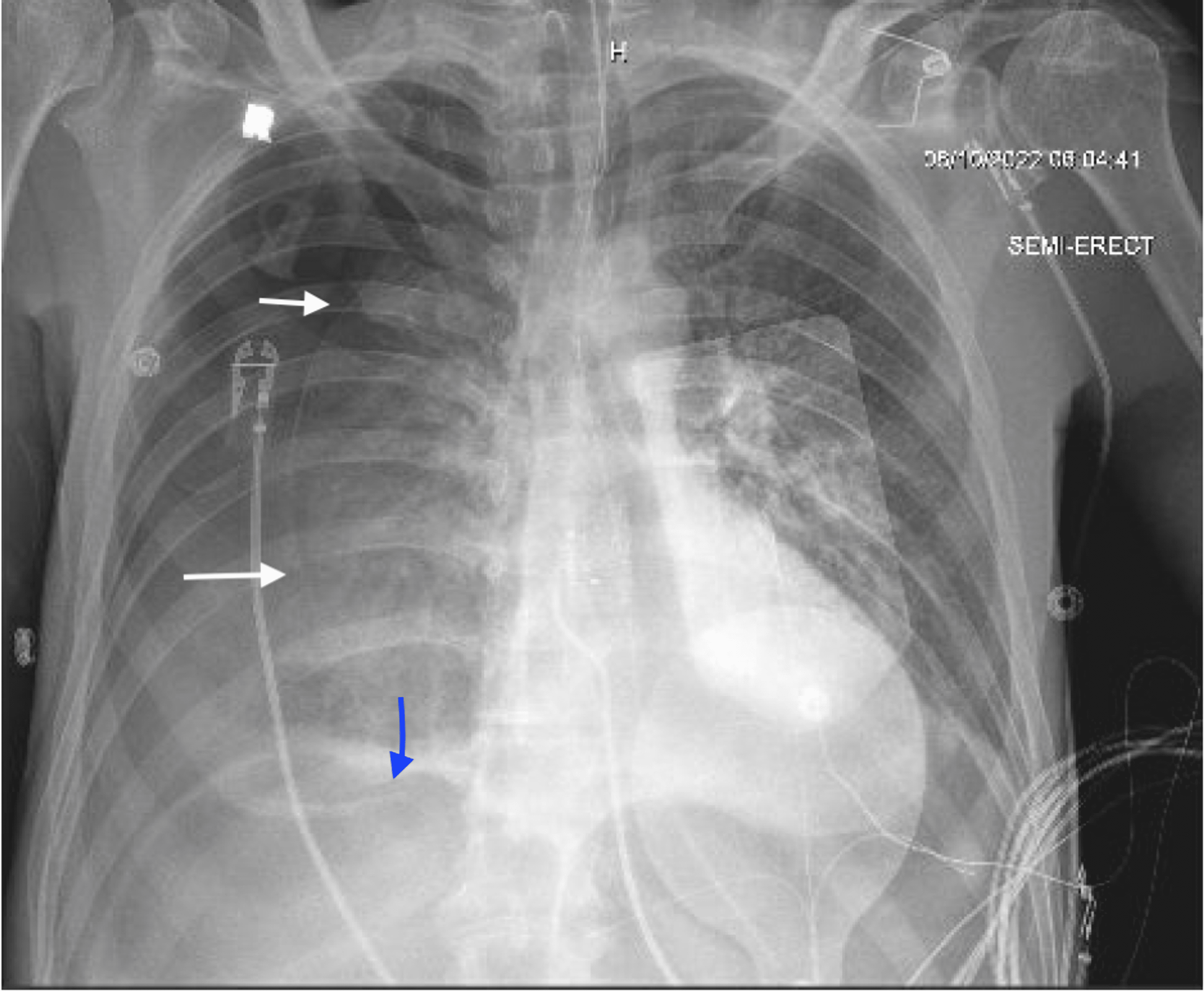 Cureus The Complication of Nasogastric Tube Insertion