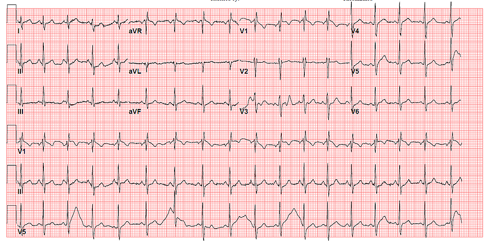 Spontaneous Pneumomediastinum in a Healthy Young Male: A Case Report ...