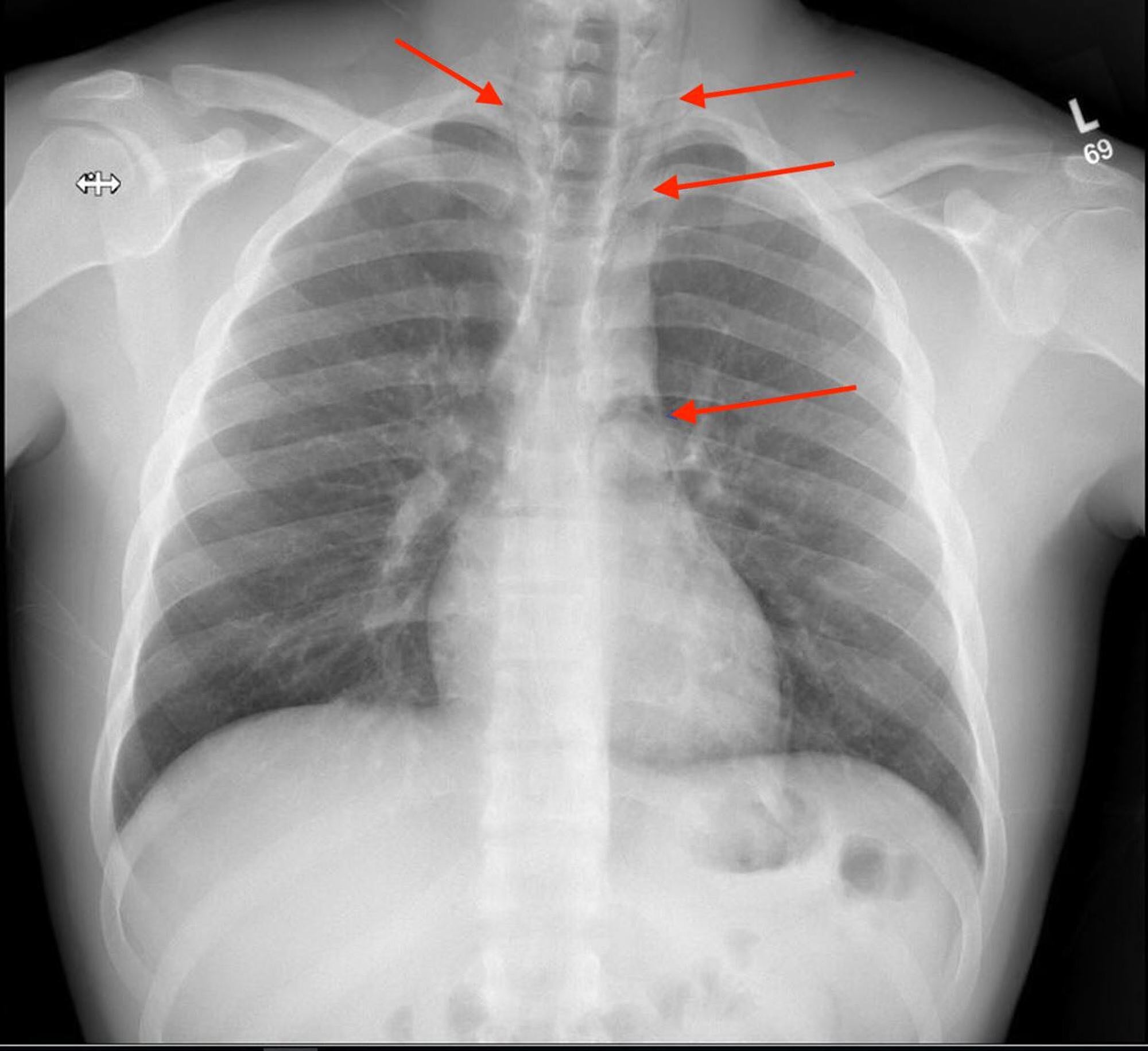 Cureus Spontaneous Pneumomediastinum in a Healthy Young Male A Case