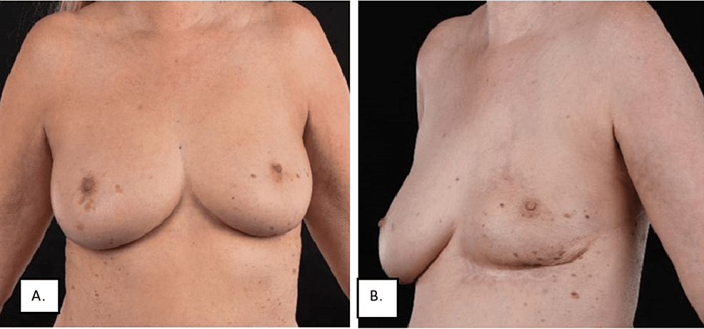 Managing Sharp Stabbing Pain After Breast Reconstruction: Causes and  Solutions