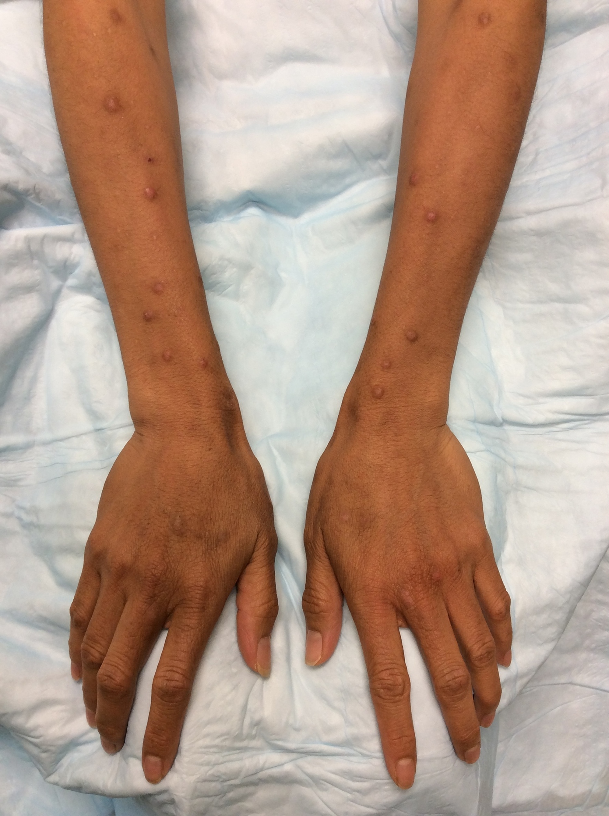 Cureus | Hyperpigmentation Due to Cyclosporine Therapy