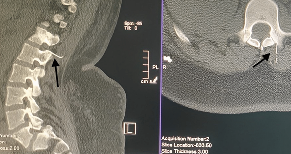 Cureus Successful Management of a Broken Spinal Needle During
